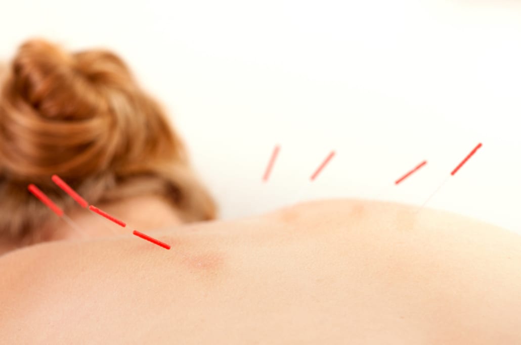 acupuncture on back