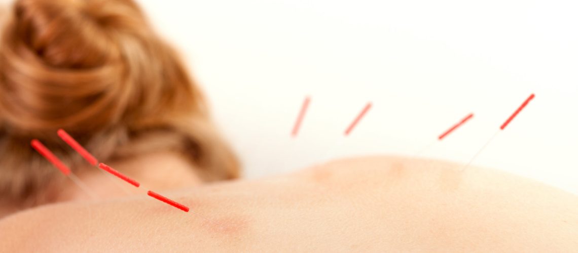 acupuncture on back
